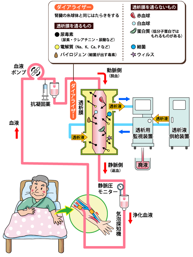 血液透析の原理